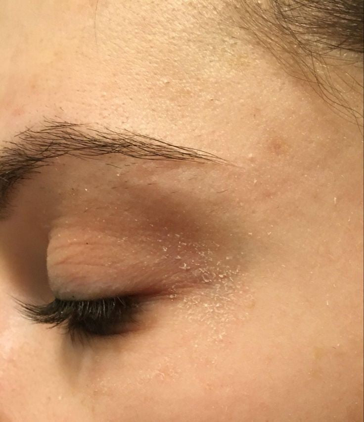 Dry Skin